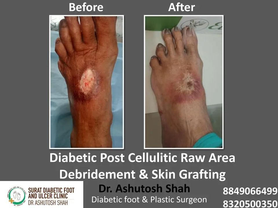 Diabetic Cellulitis and Coverage.pptx-22.webp